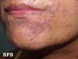 syphilis secondary