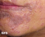 syphilis secondary