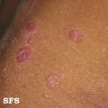 syphilis secondary