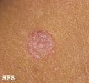 syphilis secondary