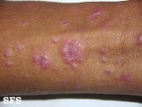 syphilis secondary