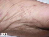 syphilis secondary
