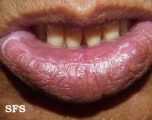 syphilis secondary