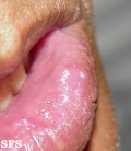 syphilis secondary