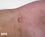 syphilis secondary