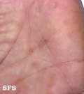 syphilis secondary