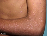 syphilis secondary
