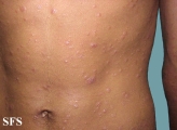 syphilis secondary