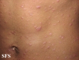 syphilis secondary