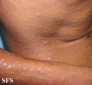 syphilis secondary