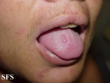 syphilis secondary