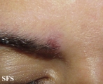 syphilis secondary