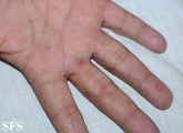 syphilis secondary