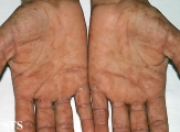 syphilis secondary