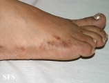 syphilis secondary