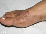 syphilis secondary