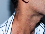 syphilis secondary