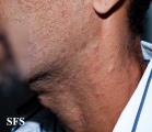 syphilis secondary