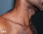syphilis secondary