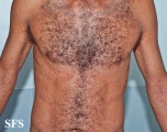 syphilis secondary