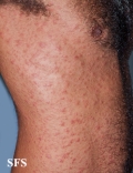 syphilis secondary