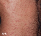 syphilis secondary