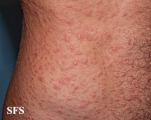 syphilis secondary