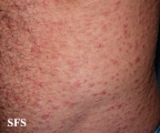 syphilis secondary