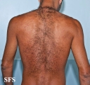 syphilis secondary