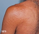syphilis secondary