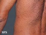 syphilis secondary