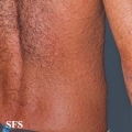 syphilis secondary