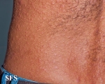 syphilis secondary