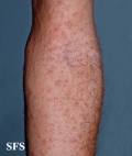 syphilis secondary