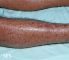 syphilis secondary