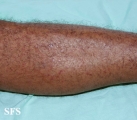 syphilis secondary