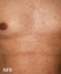 syphilis secondary