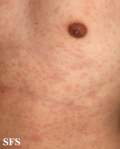 syphilis secondary
