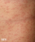 syphilis secondary
