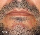 syphilis secondary