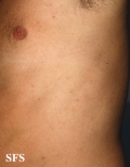 syphilis secondary