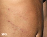 syphilis secondary