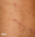 syphilis secondary