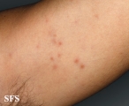 syphilis secondary