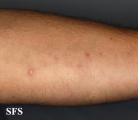 syphilis secondary