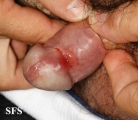 syphilis secondary