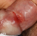syphilis secondary