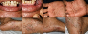 syphilis secondary
