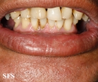 syphilis secondary