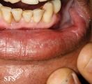syphilis secondary